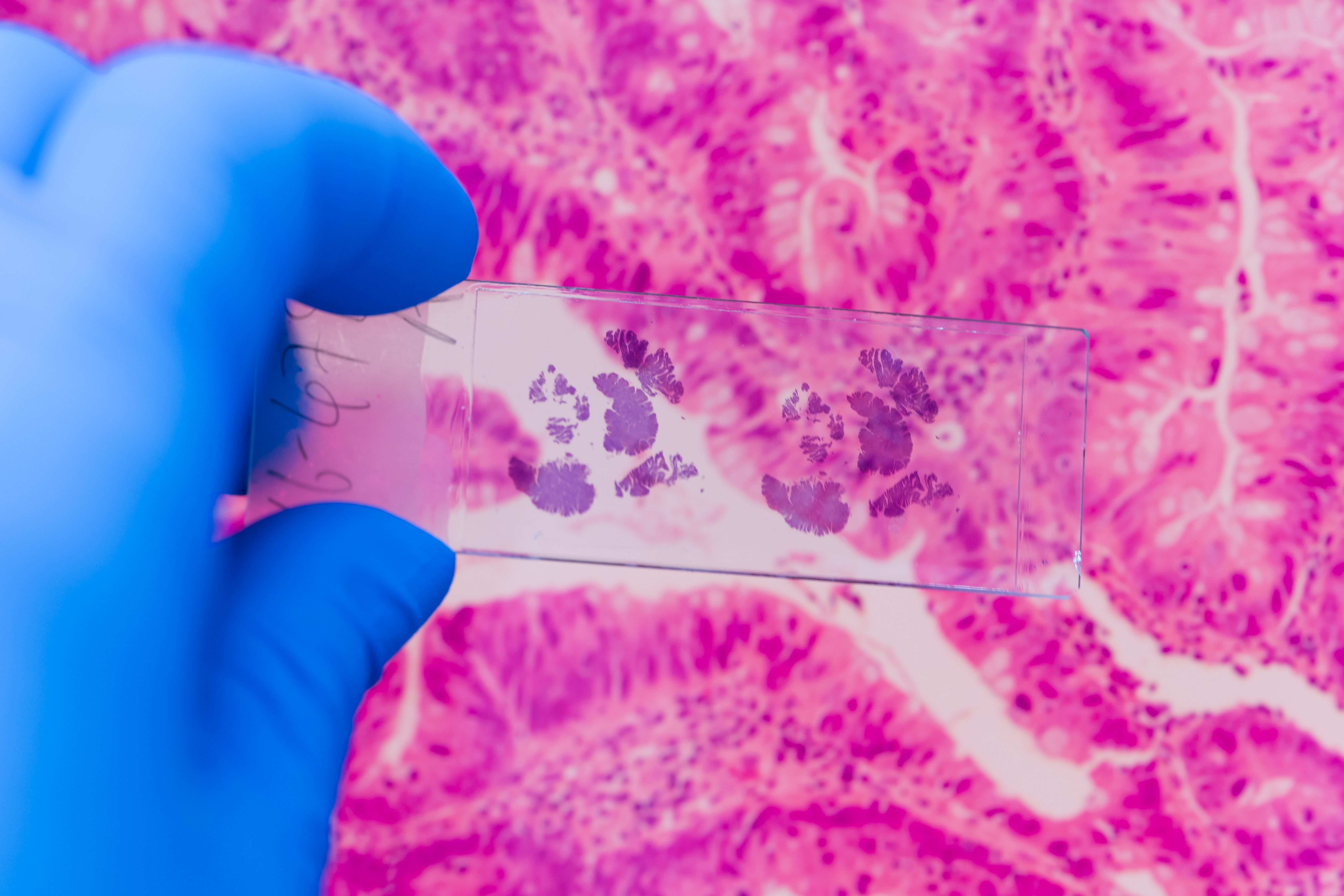Pathologist holding a histology slide of breast tissue, with a microscope picture of breast cancer tissue in the background.